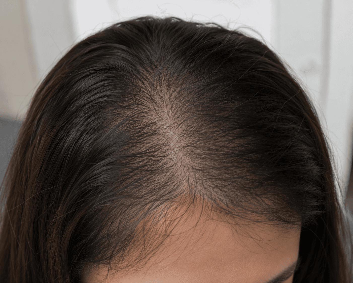 Weak and Miniaturized Hair presentation