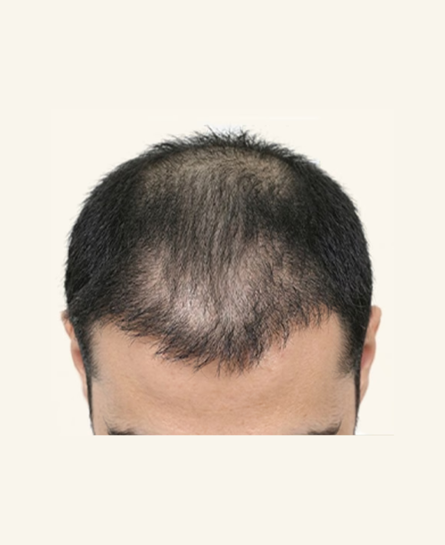 Before Treatment - Proto Clinic Hair Loss Case Study