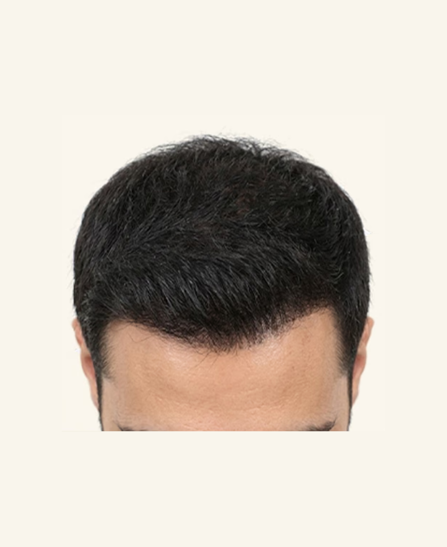 After Treatment Protocol - Proto Clinic Hair Loss Case Study