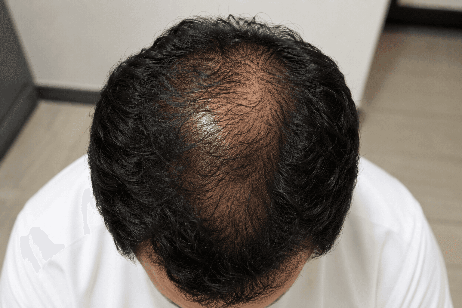 Crown and Vertex Thinning presentation