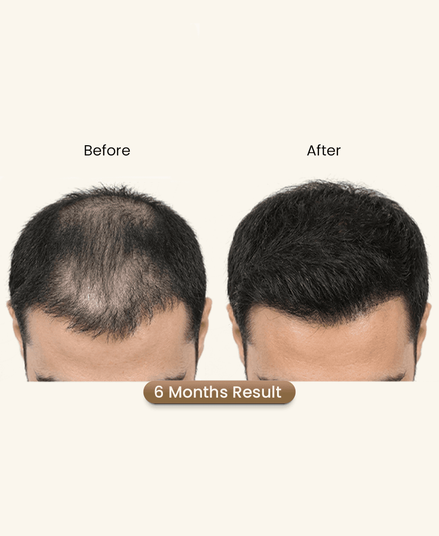Proto Clinic Hair Restoration Case Study 1