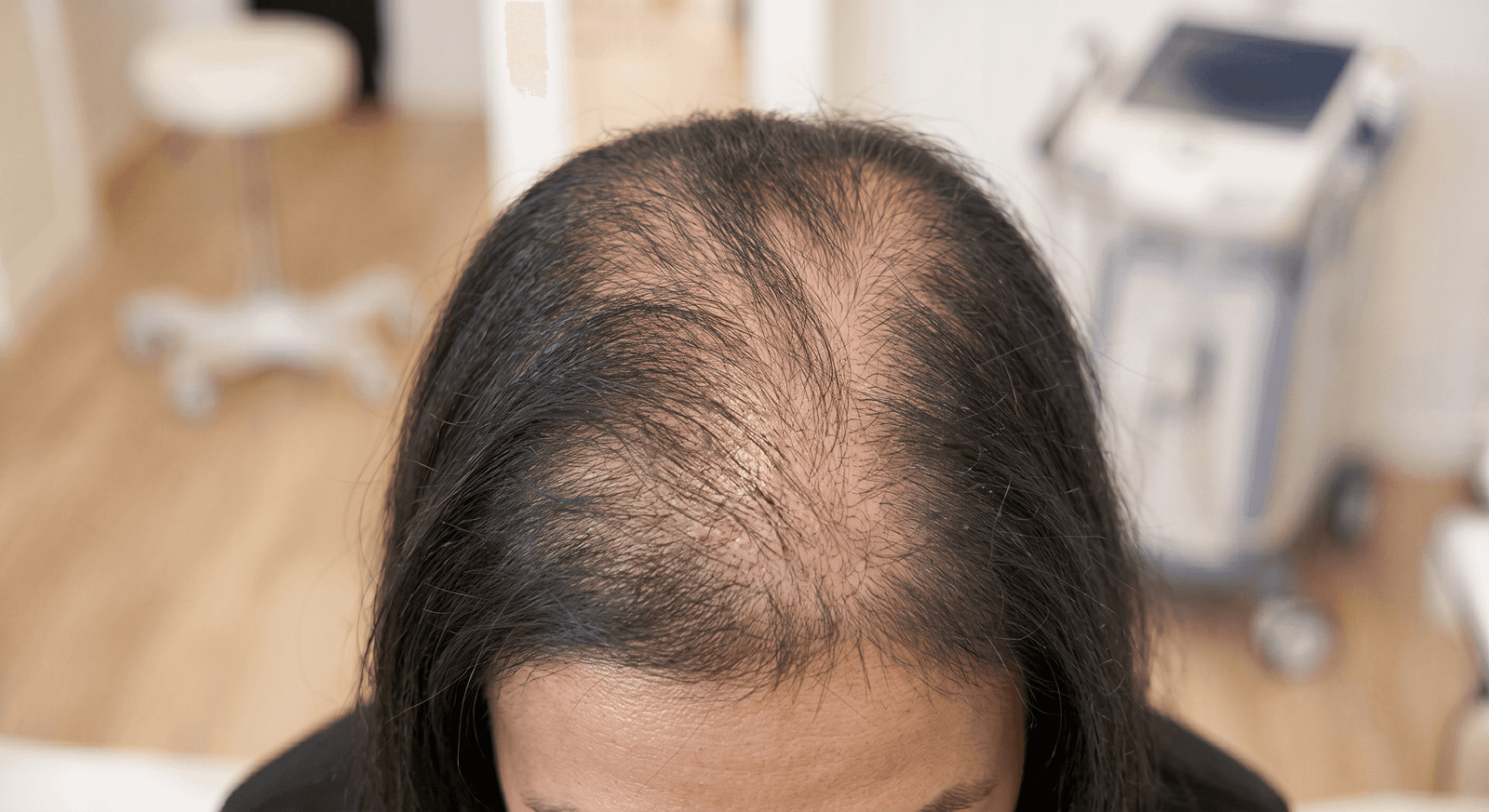 Excessive Hair Shedding presentation