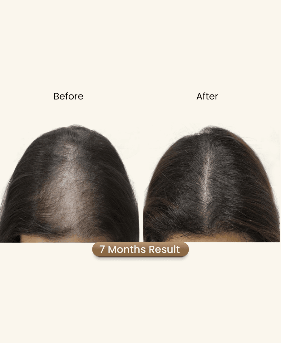 Proto Clinic Hair Restoration Case Study 3