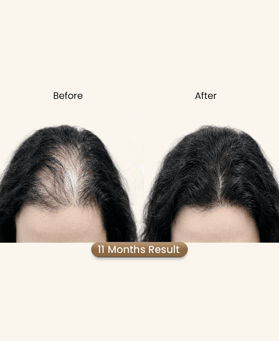 Proto Clinic Hair Restoration Case Study 2
