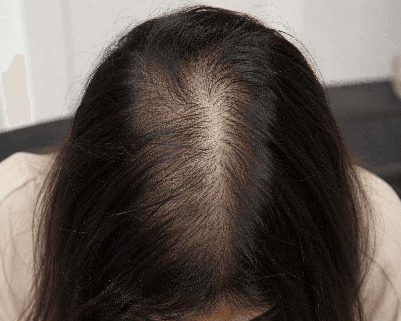 Diffuse Thinning Hair presentation