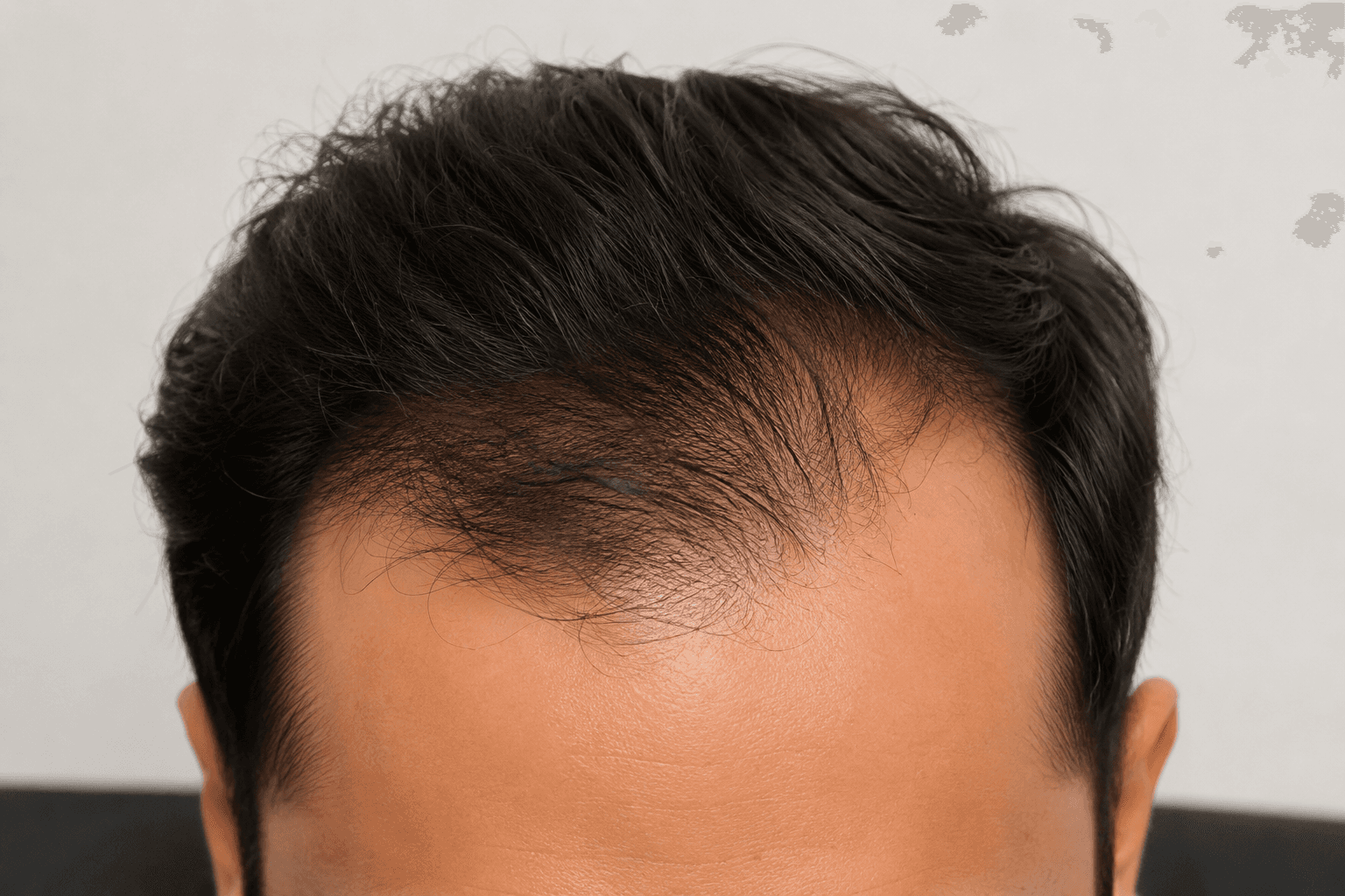 Receding Hairline presentation